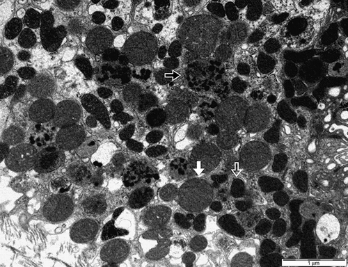 Figure 3.  The section shows many lysosomes containing dense granular materials (black arrow). Equal-sized oval mitochondria are considered to be normal (white arrow). Diverse-shaped and small-sized mitochondria that have a dense matrix are considered to be degenerated (hollow arrow) (second male, electron microscopy, ×10,000).