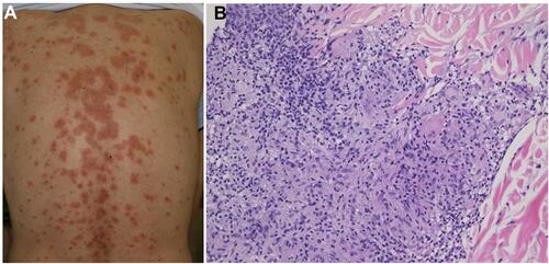 Figure 9 (A) Cutaneous sarcoidosis showing a number of annular infiltrative erythemas on the back under nivolumab therapy. (B) Epithelioid granuloma with giant cells and mononuclear cell infiltration.