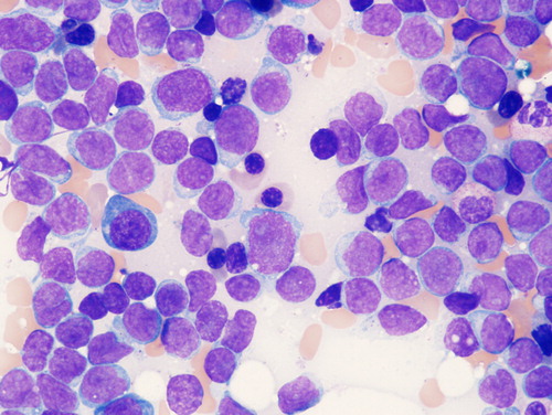 Figure 1. Bone marrow sample from a patient with ALL. Large cells with purple nuclei are leukemia cells.