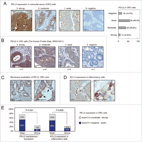 Figure 1. PD-L2 is differentially expressed in colorectal adenocarcinoma tissues. (A) Immunofluorescence (IHC) detection of PD-L2 in colorectal cancer tissues, with representative staining intensities scored as 0–3. Scale bars indicate 50 μm for panels. A numbers of cases with different scored expression levels are shown in the plot on the right (percentage indicated). (B) The representative IHC staining results as presented in the Human Protein Atlas data set. (C) Positive PD-L2 staining in the inflammatory cells adjacent to tumor cells. (D) Representative membranous distribution of PD-L2 in tumor cells. The black errors show membranous regions enriched for PD-L2. (E) The bar plot shows the percentage cases with PD-L2 expression in inflammatory cells and membranous distribution of PD-L2 in tumor cells. The chi-square test suggested that strong expression of PD-L2 associates with its membranous enriched pattern (p = 0.001), but not with its positivity in inflammatory cells.