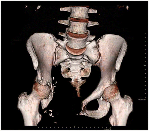 Figure 3. 3D AP volume rendering of the 3.5-year follow-up CT.