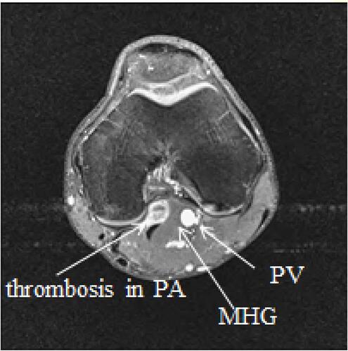 Figure 4 The left knee axial T1 with contrast MRI; thrombosis formation in the vessel wall of the popliteal artery can be observed.Abbreviations: PA, popliteal artery; PV, popliteal vein; MHG, medial head of gastrocnemius muscle.