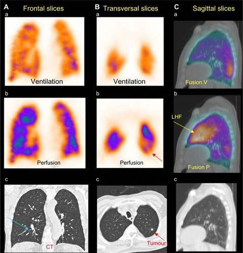 Figure 1 Patient with COPD, LHF, and a small tumor.