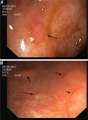 Figure 3 Endoscopic image of colonic mucosa.