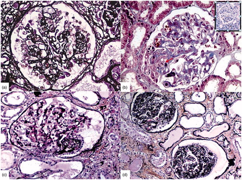 Figure 1. Photomicrographs of cFSGS show (a) global collapse of glomerular tuft wish hyperplasic and hypertrophied podocytes with overlying hypertrophied and hyperplastic podocytes (b) Hyperplastic podocytes (Ki 67 positive inset) over segmental collapsed tuft show mitosis, moderate cytoplasm with protein absorption droplets and prominent nucleoli (c) Segmental collapse with collagenized glomerular tuft having a crown of quiescent podocytes (d) Global collapse lined by row of cuboidal podocytes without mitosis and protein absorption droplets (PAS- Silver Methenamine stain a, c–d, Masson’s Trichrome-b, Immunohistochemistry Ki 67-insetd, a–c, X 40, d-X 20 original magnification).