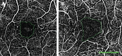 Figure 7 FAZ measurements in healthy subjects and in patients with retinal diseases. (A) A healthy 39-year-old female. Area and diameter, respectively, of FAZ: 0.114 mm2, 464 μm. (B) A 62-year-old female with DR. Area and diameter, respectively, of FAZ: 0.225 mm2, 672 μm. The green dotted line encircles the FAZ. Average over many healthy and DR subject showed similar results (see text).