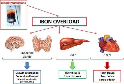 Figure 1. Major mechanism of iron overload in transfusion-dependent thalassemia. As shown in the figure, the major cause of iron overload in transfusion-dependent thalassemia is the excessive accumulation of transfusional iron that is deposited in the different organs leading to different complications such as heart failure and arrhythmias, liver disease, and endocrine gland dysfunction.