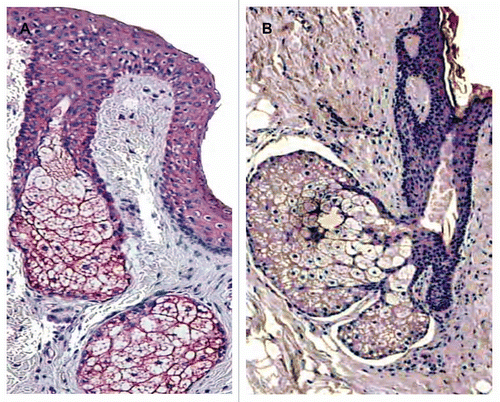 Figure 3 Localisation of CRH immunostaining in the sebaceous gland of acne patients (A) and in the normal skin of healthy controls (B). Very intensive expression of the gene in all types of sebocytes—basal, differentiating and mature cells—and keratinocytes of ductus seboglandularis in acne skin is shown (A) (x400); significant weaker and dependent upon sebocytes differentiation stage immunoreaction of sebaceous gland in normal skin (B) (x400).