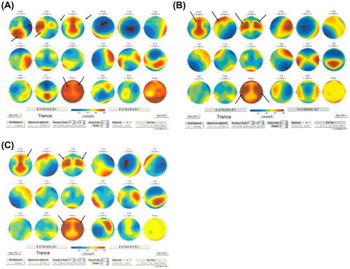 Figure 3. Quantitative EEG mapping of the subject in the trance state (left 3 × 3 maps) vs. 78 normal dextral female controls (right 3 × 3 maps): (A) Low beta band, EC condition. (B) High beta band, EC condition. (C) The subject in the trance state (left 3 × 3 maps) vs. in her normal state (right 3 × 3 maps): high beta band, EC condition.