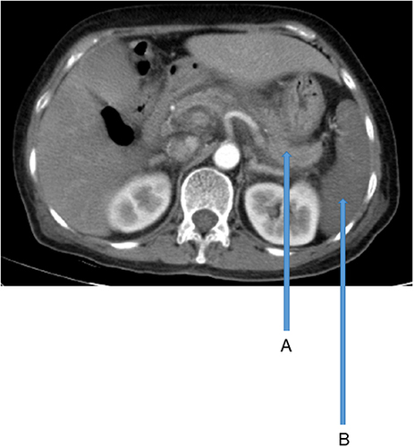 Figure 1 Abdominal CT scan upon admission for this case. (A) Acute pancreatitis is characterized by pancreatic swelling, which is more pronounced in the tail of the organ. Enhanced local density is slightly reduced, while widespread exudative fluid accumulates around the abdominal aorta, splenic artery, and anterior renal fascia. The fascia in front of the left kidney is thickened, and the interstitial spaces of abdominal fat are unclear. (B) The density of the spleen was significantly reduced, and enhancement was markedly decreased, suggesting splenic infarction. The interstitial spaces of abdominal fat were unclear.
