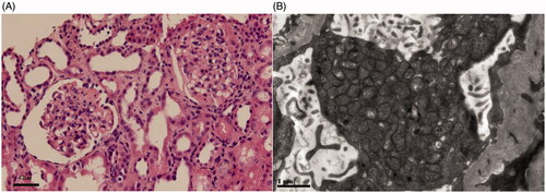 Figure 2. Renal pathological changes of the proband’s elder brother harbored COQ2 mutations. (A) The glomeruli showed segmental sclerosis and adhesion to the Bowman’s capsule wall (Light microscope, hematoxylin eosin staining, Scale bar: 42 μm). (B) Mitochondria accumulated in the podocyte with normal contour (Electron microscope, Scale bar: 1 μm).