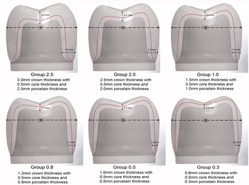 Figure 1. An illustration showing the CAD files of the different groups with overall crown thicknesses (core/porcelain). All crowns had an equal core thickness but different porcelain thicknesses. The gradual reduction in crown thicknesses resulted in a corresponding decrease in preparation depths without changing the outer dimensions (the X-imaginary line) of any of the crowns. The red dotted line denotes the core/porcelain interface.