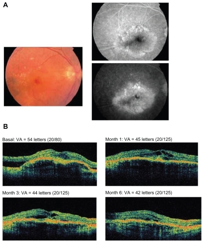 Figure 3 A 76-year-old male patient having a disciform scar in the left eye and no prior treatments received 4 injections of pegaptanib. A) Fundus photograph at baseline (left panel) and fluorescein angiography (right panel). B) Optical coherence tomography images and visual acuity (VA; Early Treatment Diabetic Retinopathy Study [ETDRS] letters) at baseline and months 1, 3, and 6.
