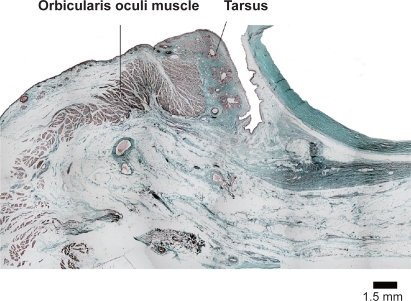 Figure 1 The preseptal orbicularis oculi muscle of the lower eyelid overrides over the pretarsal orbicularis oculi muscle. Bar = 1.5 mm.