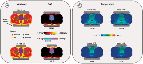 Figure 5. Predicted SAR (A) and temperature (B) distributions for two different electrode combinations, when heating a bladder cancer patient. The black contour in the temperature distributions indicates the bladder target. For temperature evaluation, the bolus temperatures at both ends of the clinically applied range were simulated (i.e., 18 °C and 10 °C) to ensure a robust conclusion regarding the optimal electrode combination, independent of the water temperature. Power was scaled such that the overall maximum predicted tissue temperature reached 45 °C. The displayed slice is at the central target location to visualize the effectiveness of target heating for different treatment setups with the same normal tissue constraints; the 45 °C maximum is not visible in this slice.