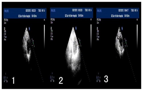 Figure 3 Change of heart ultrasound imaging before and after ultrasound treatment (parameters: FILIPS-iE33, 2D, FR31Hz, transducer: S5-1/Echo).Notes: 1: before ultrasonic treatment; 2: injection of the microbubbles with increased visualization of heart; 3: after ultrasonic treatment with decreased heart visualization to normal.