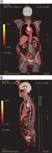 Figure 3. PET scan revealing uptake in the left cavernous sinous.( A) Coronal view ( B) Saggital view.