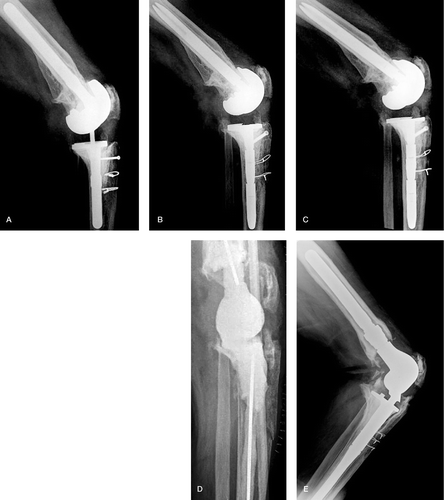 Figure 1. 3 TTOs on the same knee. A. Healed primary TTO in a 57-year-old man who underwent RTKA of the left knee. A bicortical screw proximally and 2 wires distally were used for osteotomy fixation. B. 4 years later, implant loosening and instability developed, and another RTKA with a second TTO was performed. Fixation of the osteotomy was achieved with the same osteosynthesis method as the previous TTO. C. Complete consolidation of the osteotomized fragment was seen radiographically 6 months postoperatively. D. 2 years later, knee infection occurred. The implants were removed and an articulated antibiotic-impregnated cement spacer was inserted. A third TTO was performed during removal of the infected TKA and antibiotic cement spacer implantation. The osteotomy was left unfixed to avoid introduction of metallic fixation into a contaminated wound. E. Fixation of the osteotomy with 3 wires was performed during the second stage of RTKA. At the final follow-up 2 years postoperatively, the tibial tubercle was well healed.