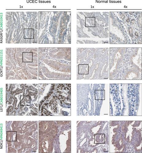 Figure 8 RASGRF1, GCNT1, LEF1 and NKD1 expression validation. Protein expression levels in UCEC as compared to those in normal tissues by IHC staining from the Human Protein Atlas database. Black square boxes represent typical normal and UCEC tissues, respectively. Scale bars represent 100 μm.