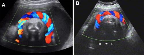 Figure 1 (A) Sonogram of nuchal cord clockwise coiling, the characteristic of blood flow: two red and one blue on the right half arc, and two blue and one red on the left half arc, it represents the umbilical cord coiling from right to left. (B) Sonogram of nuchal cord anticlockwise coiling, the characteristic of blood flow: two red and one blue on the left half arc, and two blue and one red on the right half arc, it represents the umbilical cord coiling from left to right.