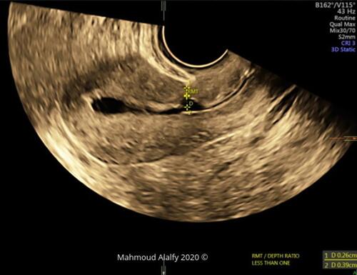 Figure 11 3D SHG image in the sagittal cut that demonstrates RMT/Depth ratio (less than 1) with a thin RMT with adhesions in front of the niche.