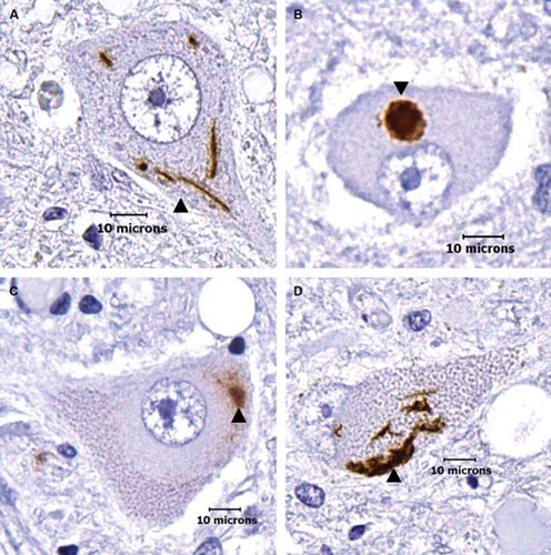 Figure 1. Morphological categories of TDP-43 immunoreactive cytoplasmic aggregates in ALS lower motor neurons. (A) Skeins: these appear as multiple string-like TDP-43-positive aggregates (arrow head). (B) Dense round inclusions: these appear as dense, round TDP-43-positive aggregates (arrow head). (C–D) Overlaps: these appear as an intermediate between skeins and dense round inclusions. In C, the TDP-43-positive aggregate appears similar to a dense round inclusion but has diffuse aggregation emerging from the inclusion body (arrow head). In D, morphology is similar to a skein, but the string-like deposits are locally condensed and form a large, dense deposit (arrow head). Note that the aggregates are seen in what otherwise appear to be morphologically healthy neurons. (Scale bar = 10μm).