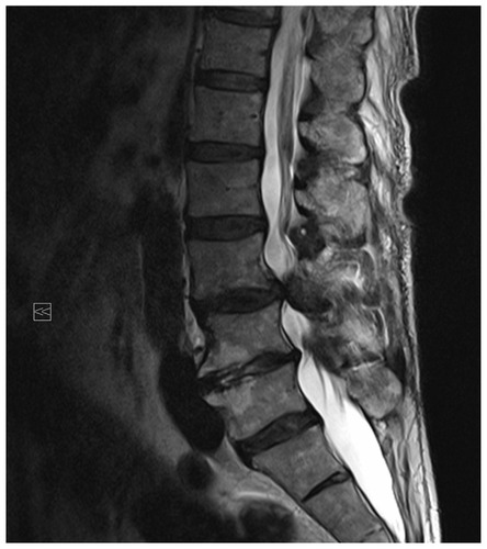 Figure 1 Magnetic resonance imaging of the lumbar spine showing disc prolapse at L3/L4 with consecutive stenosis of the lumbar canal.