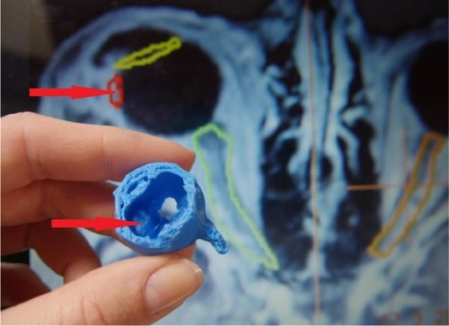 Figure 5 Printed 3D model of the eye with intraocular uveal melanoma, middle-stage T2 (arrows indicate tumor mass), with stereotactic planning scheme on the background.