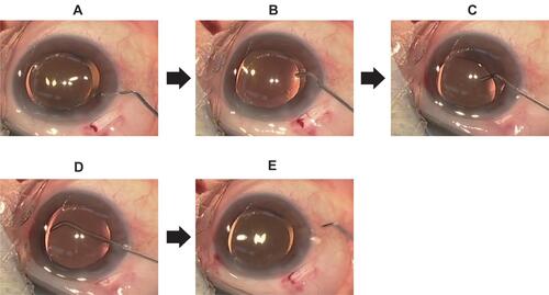 Figure 1 A cannula is inserted via a side port, and the anterior chamber is flushed for several seconds (A and B). The opposite edge or the side edge of the IOL using the tip of the needle is lifted and the stream of solution is directed behind the IOL (C). Once the anterior chamber has been flushed for several seconds, the needle is removed while maintaining the solution stream (D and E).