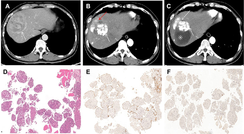 Figure 8 Images in a 51-year-old man (case 91) with S8 VETC, MTM-HCC, BCLC C stage and baseline serum AFP level of 450.7 ng/mL. (A) baseline HAP CT image (8.9cm, white arrow); (B), HAP CT after the first session of cTACE: defect and about 50% lipiodol deposition (white arrow), tumor response is PR according to mRECIST (alive lesion: red arrow); (C), HAP after the second session of cTACE: lipiodol further deposed in alive lesion and original deposition remained unchanged and partial necrosis (✳); (D), HE of HCC showed tumor cell was MTM; (E), HCC was VETC according to CD34 IHC; (F), CK19 IHC was negative (×40 magnification).