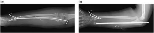 Figure 3. Anteroposterior (a) and lateral (b) views of radiographs at immediately after surgery.
