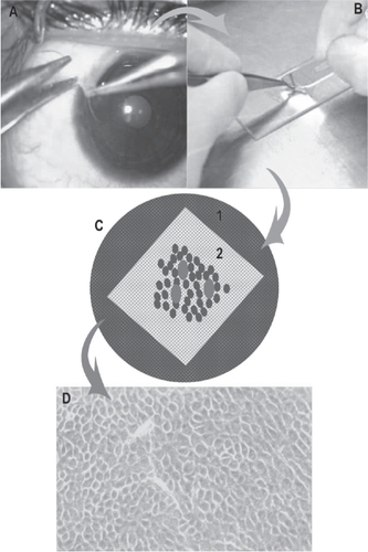 Figure 4 Schematic diagram showing the steps in cultivation of limbal epithelial stem cells. A: Technique of limbal biopsy (See text for details). B: Processing of tissue in the laboratory and making the explant culture. C: Petridish, glass slide (white) with de-epithelialized human amniotic membrane with explants (red dots) with growing cells around it (blue dots). D: Monolayer of cells (10–14 days old) under phase contrast microscope.