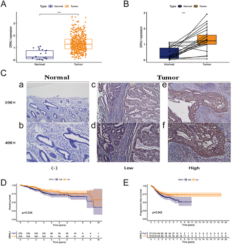 Figure 1 Expression of GRHL1 in endometrial cancer and adjacent normal tissues and its prognostic assessment in endometrial cancer. (A) GRHL1 was overexpressed in the TCGA cohort. (B) In the TCGA cohort, GRHL1 was over-expressed in the tumor relative to the noncancerous tissues. (C) IHC staining analysis showed that GRHL1 expression was low in paracancerous tissues (a and b) and up-regulated in EC tissues (c–f). (D) Kaplan-Meier analysis of OS of individuals with EC with GRHL1 gene expression in the TCGA database. (E) Kaplan-Meier analysis of PFS of individuals with EC with GRHL1 gene expression in the TCGA database. (***p < 0.001).