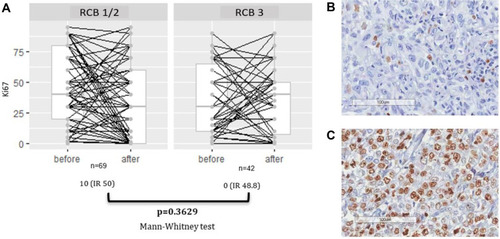 Figure 3 (A) The correlation between change in Ki67 value and RCB status in patients with residual disease. In such cases, the median absolute Ki67 reductions were 10% and 0% in patients with good response (RCB1/2) and poor response (RCB 3), respectively. (B) Immunohistochemical Ki67 staining in TNBC, representative image of Ki67 with low expression (magnification, x 200). (C) Representative image of Ki67 with high expression (magnification, x 200).