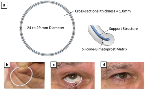 Figure 1. (a) Schematic of the bimatoprost SR ocular insert. An internal polypropylene structural ring covered with a silicone-drug matrix for slow release of bimatoprost. (b) Photograph showing the insert outside the eye. (c) Placing the bottom part of the ring in the lower fornix. (d) After the insert is in place only a small part of it is visible in the medial canthus [Citation86].
