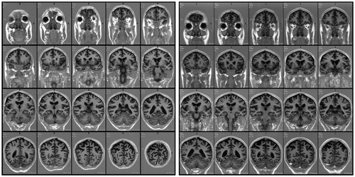 Figure 2. Coronal slices from the first (left) and follow-up (right) MRI examinations further showing posterior bi-parietal atrophy and demonstrating relative sparing of medial temporal and frontal cortices.