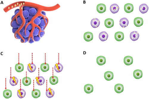 Figure 1. Mechanisms of BNCT in cancer.Patients were injected intravenously with a boron delivery agent before and sometimes during treatment (A). Cancer cells selectively absorb the boron-delivery agent with little uptake by normal tissues (B). The boron nucleus absorbs neutrons and undergoes nuclear fission, yielding an alpha particle and a 7Li. The range of the particle is 4-7 μm, equal to the diameter of a cell (C). Tumor cells were eliminated following BNCT therapy without causing considerable damage to normal tissue cells (D).