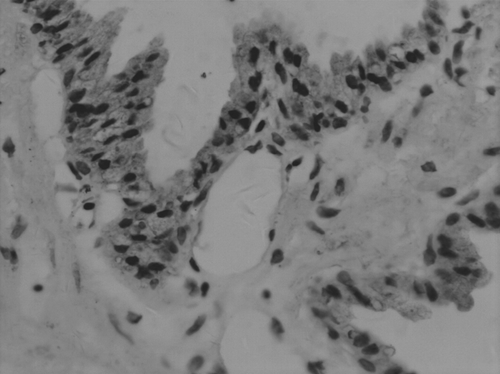 Figure 2 Expression of hTERT in BPH (SP, × 400) Staining intensity was detected in the cytoplasm.