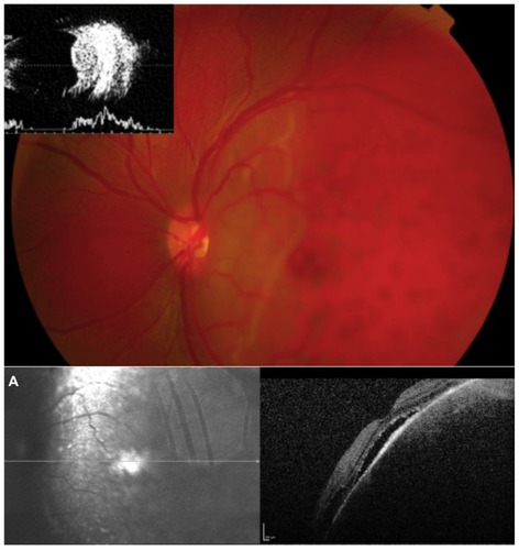 Figure 1 Fundus photograph showing diffuse, orange choroidal thickening with more prominent localized thickening in the temporal quadrant.