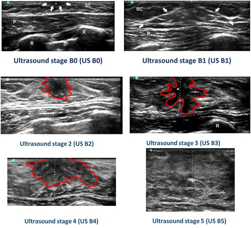 Figure 1. The ultrasound breast developmental stages. Ultrasound stage (US) B0 was defined as immature glandular breast tissue beneath the papilla, recognised as a small dark (hypoechoic) area. In US B1, the breast tissue is triangle-shaped and hyperechoic (light) compared to the surrounding tissue, but not compared to the pectoral muscle, with or without a small dark centre. In stage US B2, there is a hypoechoic centre that appears roundish. The surrounding breast tissue appears hyperechoic. In stage US B3, the hypoechoic centre is “spider-shaped”, although the breast tissue appears hyperechoic. US B4 was defined when the hypoechoic centre, (also observed in US B2 and B3), had a rounder shape. In US B5, mature breast tissue was observed as a heterogeneous mass without any hypoechoic centre. One or more ribs (R) are observed in most images, and the pectoral muscle (P) is observed on all images (Bruni et al., Citation1990; Bruserud, Citation2018; García, Citation2000).