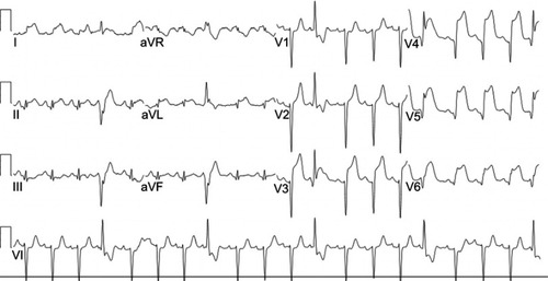 Figure 1 ECG, ST waves elevation in anterolateral leads, pathologic Q waves in lateral leads, ventricular ectopic beats.