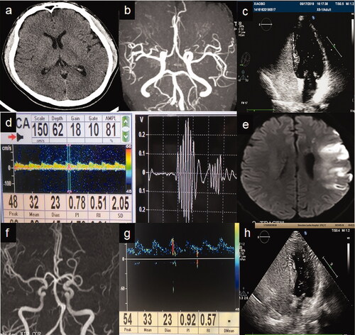 Figure 1. Patient 1. (a) Emergency head computed tomography before intravenous thrombolysis showing no obvious abnormality. (b) Brain magnetic resonance angiography (MRA) showing no obvious abnormality. (c) Contrast-enhanced transcranial Doppler (c-TCD) showing a signal of a microbubble that overflowed in the resting state. (d) Contrast-enhanced transthoracic echocardiography showing 20–30 microbubbles per section in the resting state in the left atrium at the second cardiac cycle. Patient 2. (e) Diffusion-weighted imaging sequence showing an acute infarction in the left temporal lobe and frontotemporal junction. (f) MRA showing severe stenosis of the M2 segment of the left middle cerebral artery (MCA), which had sparse distal branches. (g) c-TCD showing a small amount of microbubbles in the resting state. (h) Contrast-enhanced transesophageal ultrasound showing approximately 20 microbubbles per section per frame.