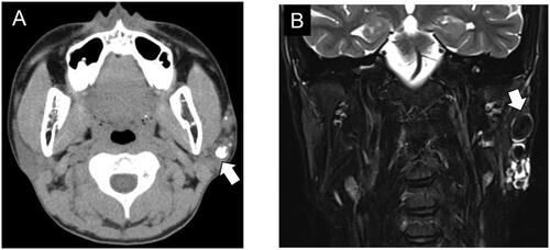 Figure 1. Preoperative findings. (A) Plain axial CT image shows calcified materials of various sizes (white arrow) in the left parotid gland. (B) Coronal T2-weighted MRI shows a hyperintense, lobulated lesion with multiple hypointense areas (white arrow) consistent with phleboliths in the left parotid gland.