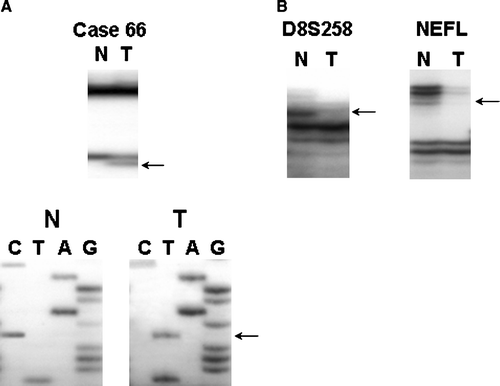 Figure 1.  Representative results showing SSCP, Sequencing and LOH analyses of the DBC2 gene in gastric cancer. A. SSCP analyses of case No. 66 showed aberrant band (arrow) as compared to SSCP from corresponding normal tissue. The mutations were missense mutation; a C to T at codon R275W in BTB/POZ domain of the gene. B. Representative results of loss of heterozygosity at microsatellite markers, D8S258 and NEFL (N, normal; T, tumor). Arrows indicate allele exhibiting LOH.