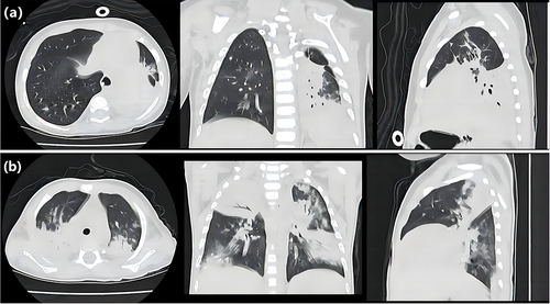 Figure 2 High-resolution CT scans of the chest. (a) Multiple consolidations in the left lung and compensatory emphysema of the right lung in a 1-year-old child with severe adenovirus pneumonia with PB. (b) Areas of airspace consolidations in the left lung and the superior lobe of the right lung in a 11-monthsold child diagnosed with severe adenovirus pneumonia without PB.