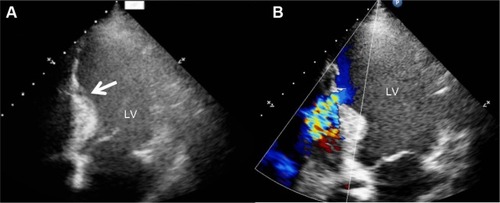 Figure 5 Echocardiography after the operation.Notes: Echocardiography showed remnant VSD after the operation. (A) Remnant VSD (arrow) and (B) further delineation with use of color-flow Doppler.Abbreviations: VSD, ventricular septal defect; LV, left ventricular.