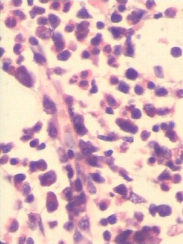 Figure 1. Bone marrow biopsy showing accumulation of mature plasma cells around blood vessels in case of infection (haematoxylin–eosin, ×40).