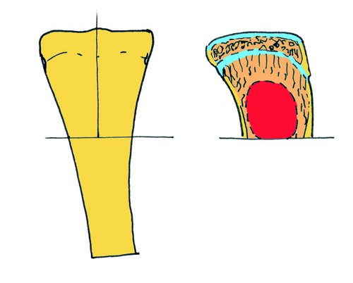Figure 2. The frontal and lateral aspects of the proximal tibia. A. The tibia was divided along the lines as drawn. B. Tissue was harvested from the volume indicated by the dashed line.