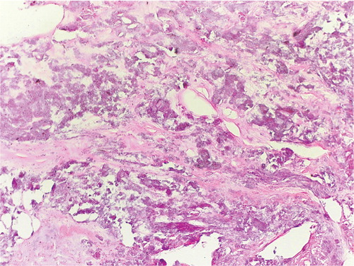 Figure 4. Histological picture showing dystrophic calcification in the necrotic tissue without any viable cells. (Stain: hematoxylin and eosin; original magnification: × 20)