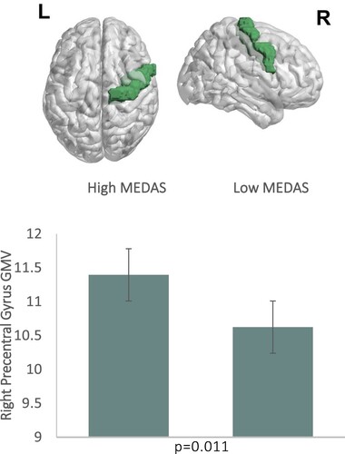 Figure 3. (Upper Panel) Right Precentral Gyrus, visualised with the BrainNet Viewer [Citation49] (Lower Panel) Right Precentral Gyrus GMV by MEDAS groups.